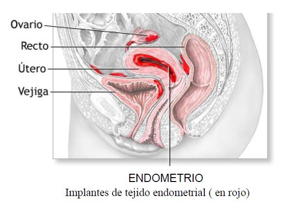 Endometriose-Tipos.JPG