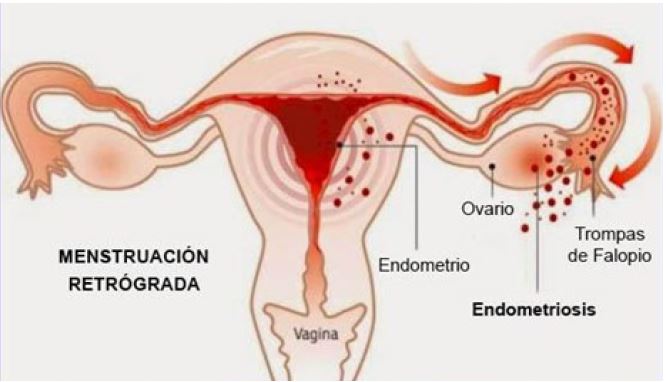 Endometriose-Causas.JPG