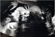diagnóstico prenatal coruña