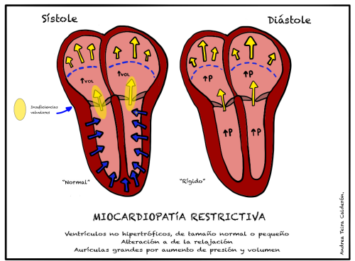 miocardiopatia_restrictiva.png